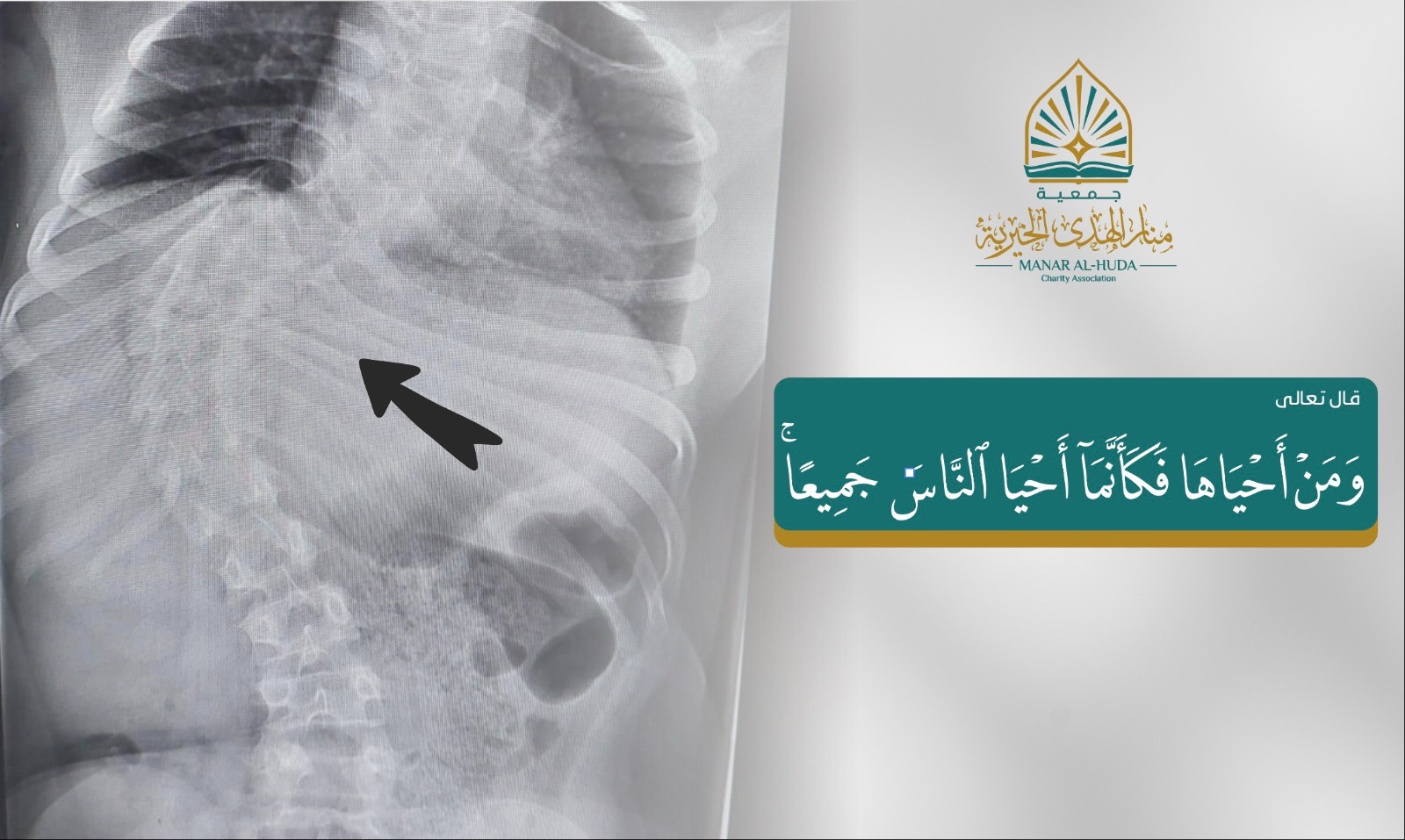 صورة بنت عمرها 11 سنة غير كويتية تعاني من انحناء في العمود الفقري بحاجة لتدخل جراحي.